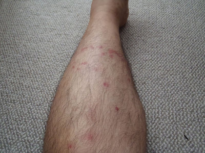 ２日後、腫れはありませんが････とても痒い････